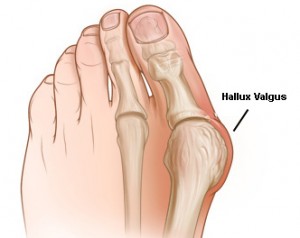 HalluxValgus