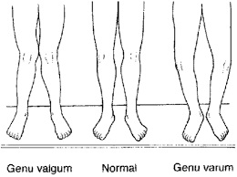 genu valg var