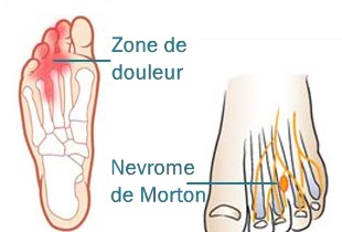morton