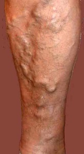 varices